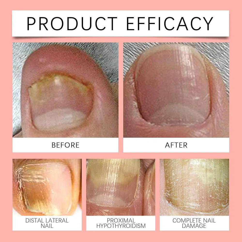 Parches reparadores uñas con hongo